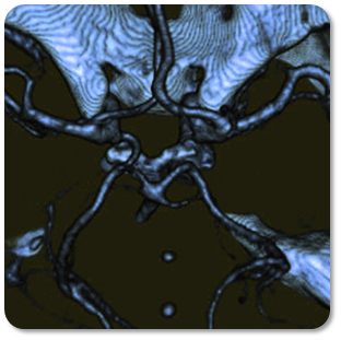 Example: Computed tomopgrahy (CT) angiograph of an aneurysm