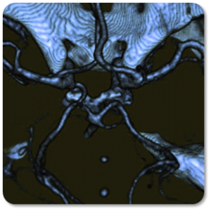 CT of an aneurysm